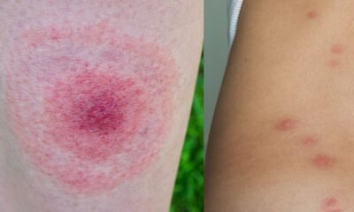 Mosquito Bites vs Spider Bites