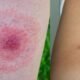 Mosquito Bites vs Spider Bites
