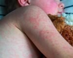 measles colorado 2025 MMR vaccine baby infected travel mexico public health