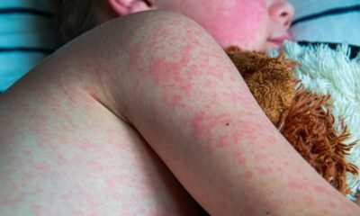 measles colorado 2025 MMR vaccine baby infected travel mexico public health