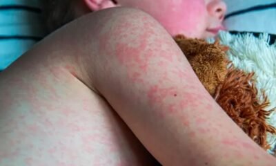measles-outbreak-colorado-2025
