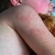 measles-outbreak-colorado-2025