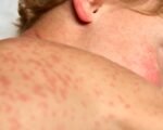 measles symptoms red rash vaccination clinic fort wayne