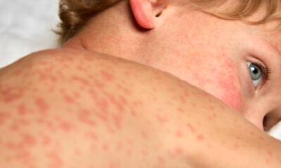 measles symptoms red rash vaccination clinic fort wayne
