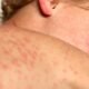measles symptoms red rash vaccination clinic fort wayne