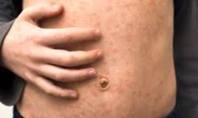 Measles outbreak Colorado Springs Denver International Airport