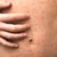 Measles outbreak Colorado Springs Denver International Airport