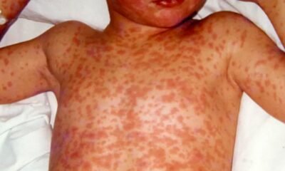 measles rash