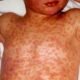 measles rash