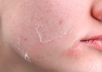 medication risks sun exposure