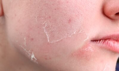 medication risks sun exposure