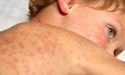 measles outbreak