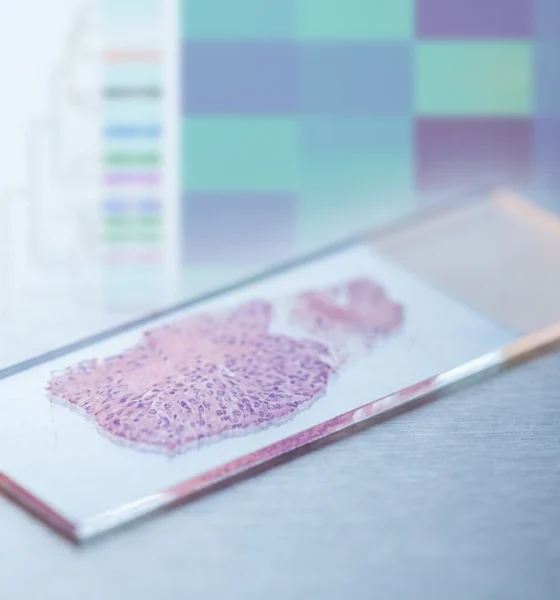 Genomic test spares node-positive breast cancer patients from chemotherapy in OPTIMA trial.